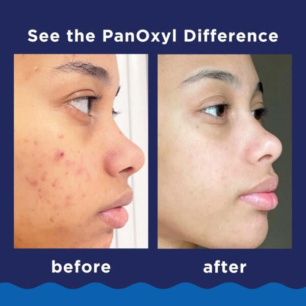 PanOxyl Acne Foaming Wash Benzoyl Peroxide 10% Maximum Strength 156G - Image 2