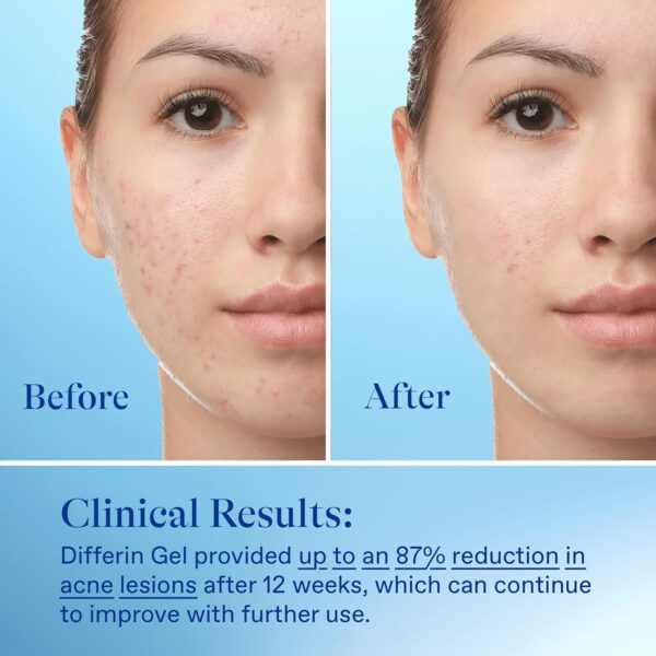 Differin Adapalene Gel 0.1% Acne Treatment 15g - Image 2