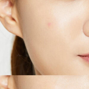 Cosrx Acne Pimple Master Patch